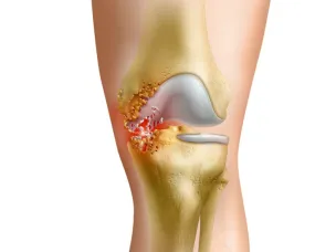 Какие инфекционные заболевания могут дать осложнение на суставы.